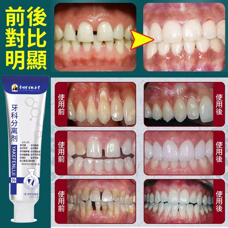 【改善牙齦腫痛、敏感、出血、牙齒鬆動問題】牙齒分離劑牙膏